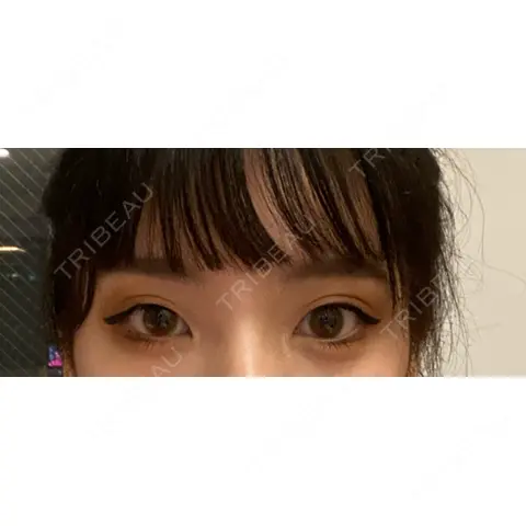 眼瞼下垂（切開） / 目尻切開 / タレ目形成・グラマラスライン（切開） 目白ポセンシアクリニック AFTER