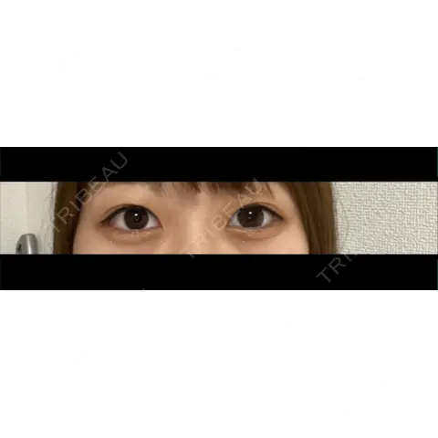 二重埋没 ながしまクリニック AFTER
