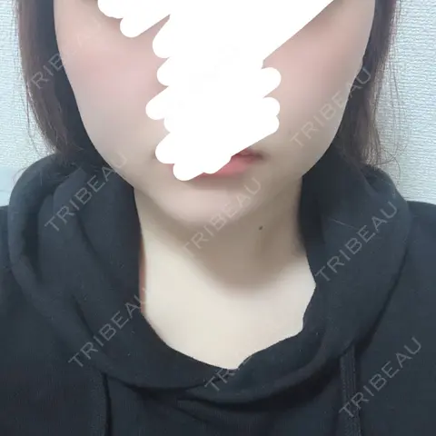 脂肪吸引（顔） BIANCA銀座 BEFORE