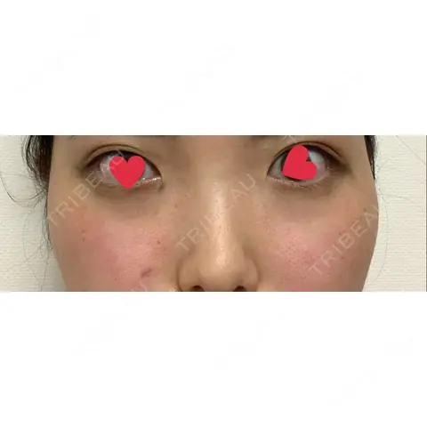 目頭切開 OZI SKIN CLINIC（オジスキンクリニック） AFTER