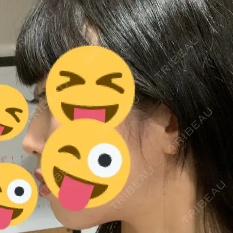 その他（鼻） 聖心美容クリニック 大阪院 AFTER