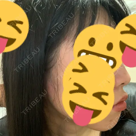 ヒアルロン酸注入（あご） 聖心美容クリニック 大阪院 AFTER