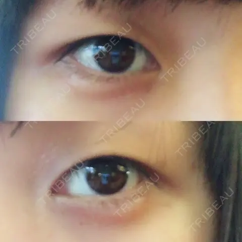 二重埋没 湘南美容クリニック 渋谷アネックス院 AFTER