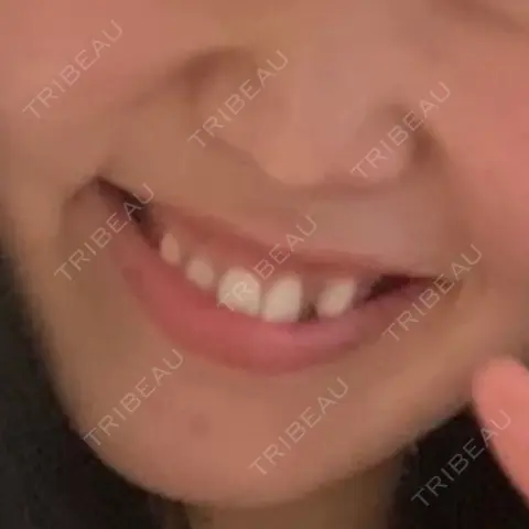 ガミースマイル手術 / 口角挙上 / ボトックス（口角） / その他（口元） 水の森美容クリニック 大阪院 AFTER