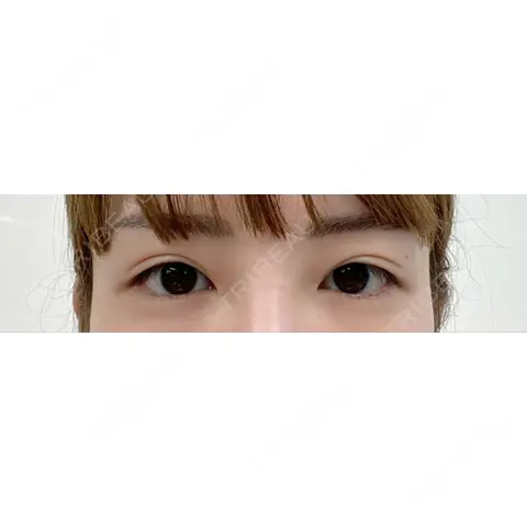 二重切開 / 上まぶたの脂肪取り プリモ麻布十番クリニック AFTER