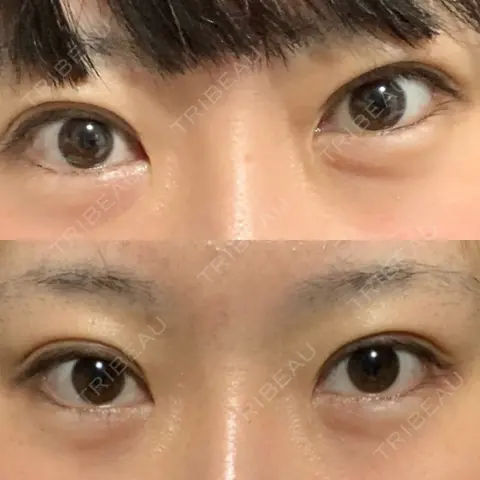 蒙古ひだ形成 R.O.clinic AFTER