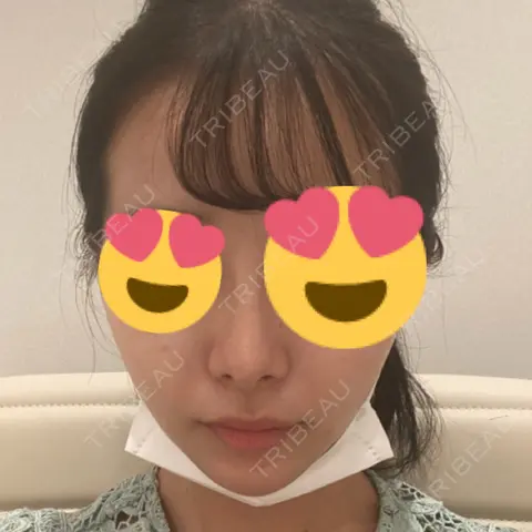 スレッドノーズ 共立美容外科 渋谷院 AFTER