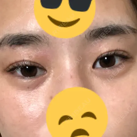 目尻切開 / タレ目形成・グラマラスライン（切開） サラ美容外科 AFTER