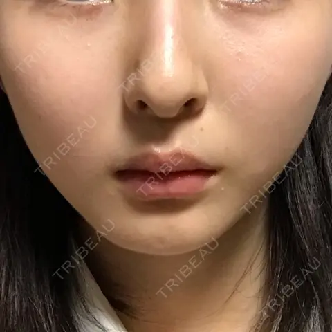 脂肪溶解注射（顔） 湘南美容クリニック 岡山院 AFTER