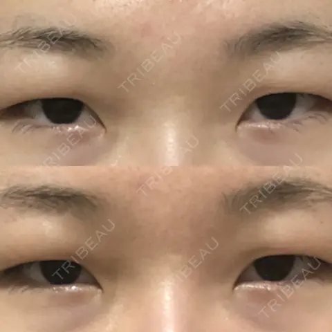 眉下切開 聖心美容クリニック 六本木院 AFTER