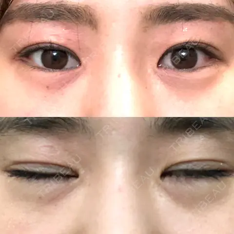 目頭切開 まりもクリニック AFTER