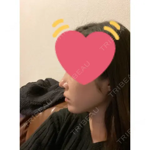 小鼻縮小（切開） / 鼻翼基部形成（貴族手術） 新宿ラクル美容外科クリニック 新宿院 AFTER
