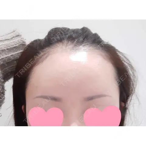 アートメイク（ヘアライン） トイトイトイクリニック 池袋院 AFTER