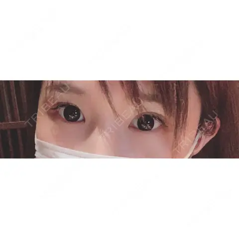 二重切開 / 目頭切開 / 眼瞼下垂（切開） すなおクリニック AFTER