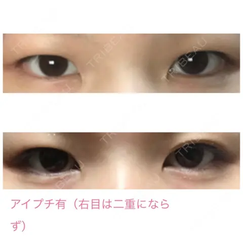 二重埋没 水の森美容クリニック 大阪院 AFTER
