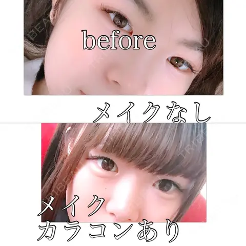 二重切開 / 目頭切開 / 眼瞼下垂（切開） / 軟骨移植 / その他（鼻） エートップ美容整形外科 AFTER