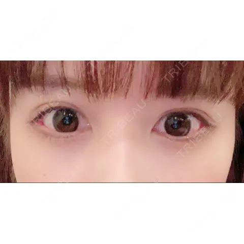 二重切開 / 上まぶたたるみ取り 酒井形成外科 AFTER