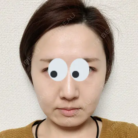 脂肪溶解注射（顔） Beauty Clinic the GINZA AFTER