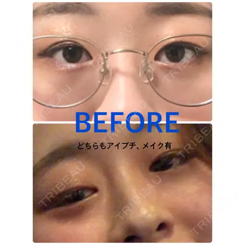 二重埋没 EMMA CLINIC（エマクリニック） BEFORE