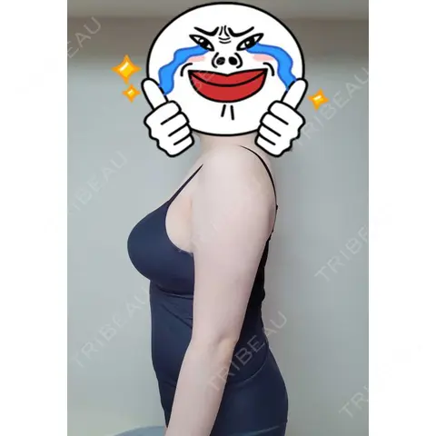 脂肪吸引（二の腕） 湘南美容クリニック 千葉センシティ院 AFTER