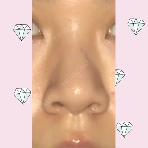 鼻尖形成（切開） / 小鼻縮小（切開） / 軟骨移植 / 鼻孔縁挙上 / 鼻尖縮小 ヴェリテクリニック 大阪院 AFTER