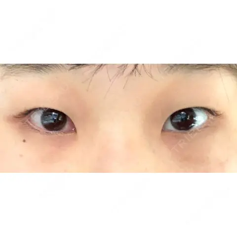 二重埋没 ながしまクリニック AFTER