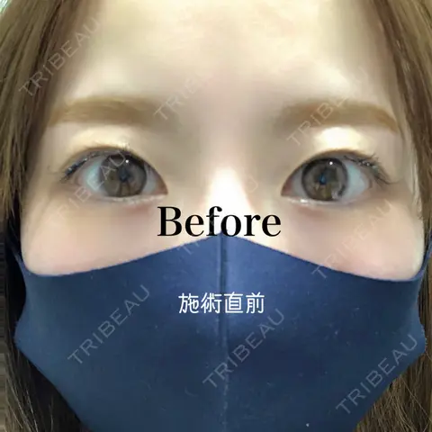 二重埋没 X CLINIC 恵比寿院 BEFORE