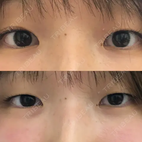 二重埋没 EMMA CLINIC（エマクリニック） BEFORE