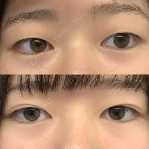 二重切開 品川美容外科 千葉院 AFTER