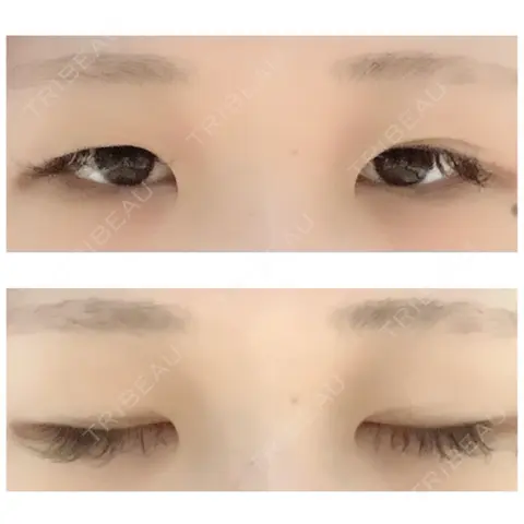 二重埋没 / 目頭切開 共立美容外科 仙台院 AFTER