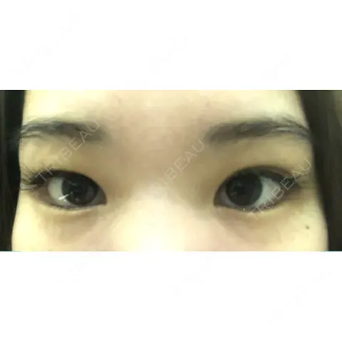 二重埋没 / クマ治療 R Beauty CLINIC 銀座院 AFTER