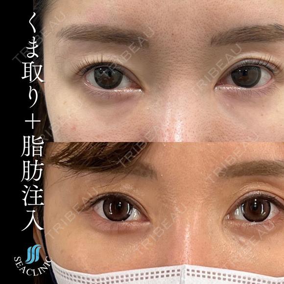 目の下のクマ取り before画像 メイン用