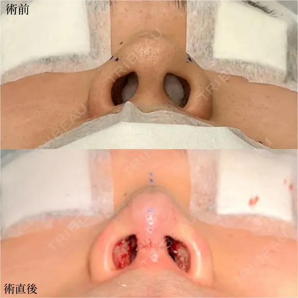 鼻尖形成3D法＋軟骨移植 before画像 メイン用