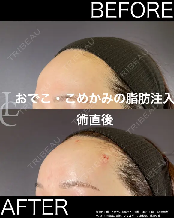 脂肪注入＋ナノファット全顔入れ放題（額＋こめかみの部分の症例） after画像 メイン用