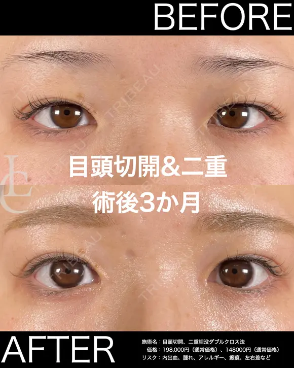 人気♥目頭切開＋切らない二重 before画像 メイン用