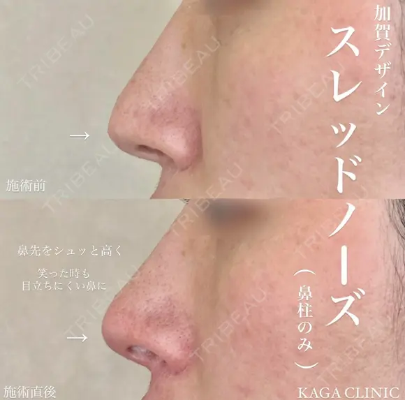 加賀デザイン×スレッドノーズ after画像 メイン用