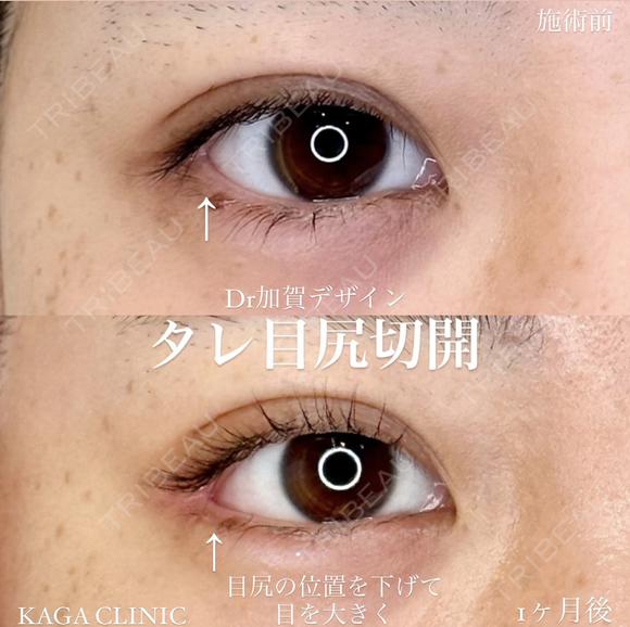 加賀デザイン×タレ目尻切開 after画像 メイン用
