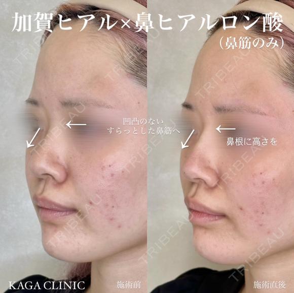 加賀ヒアル×鼻ヒアルロン酸 before画像 メイン用