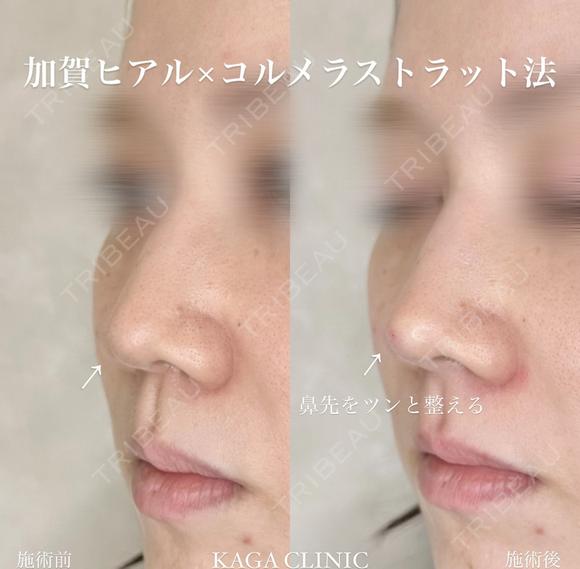 加賀ヒアル×鼻ヒアルロン酸 before画像 メイン用