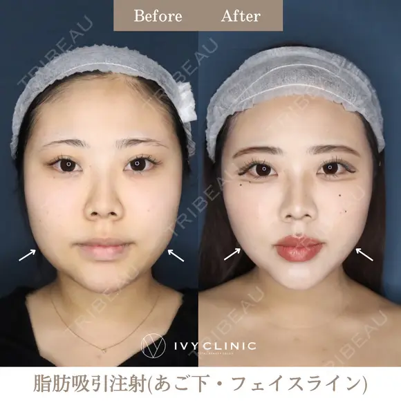 脂肪吸引注射（あご下・フェイスライン） before画像 メイン用