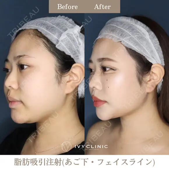 脂肪吸引注射（あご下・フェイスライン） after画像 メイン用