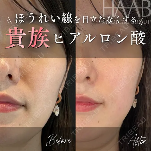 貴族ヒアルロン酸 before画像 メイン用