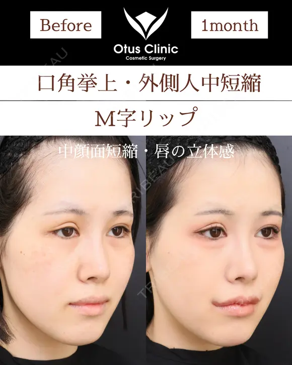 口角挙上・外側人中短縮・M字リップ before画像 メイン用