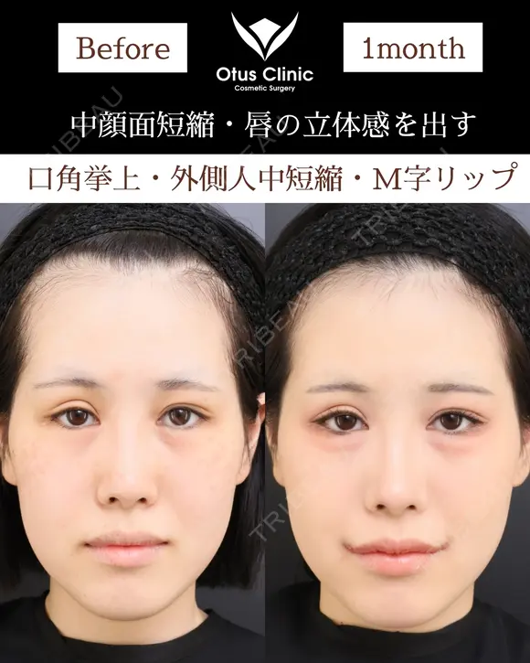 口角挙上・外側人中短縮・M字リップ 30日後 メイン用