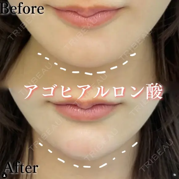 顎　ヒアルロン酸 before画像 メイン用