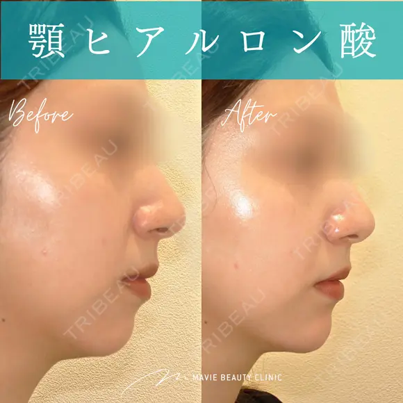 ヒアルロン酸注入（あご） after画像 メイン用