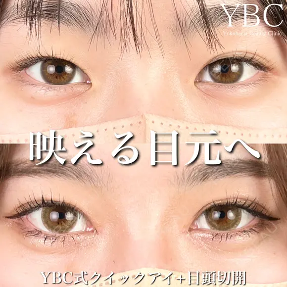 【💖YBC式クイックアイ+目頭切開💖】 after画像 メイン用