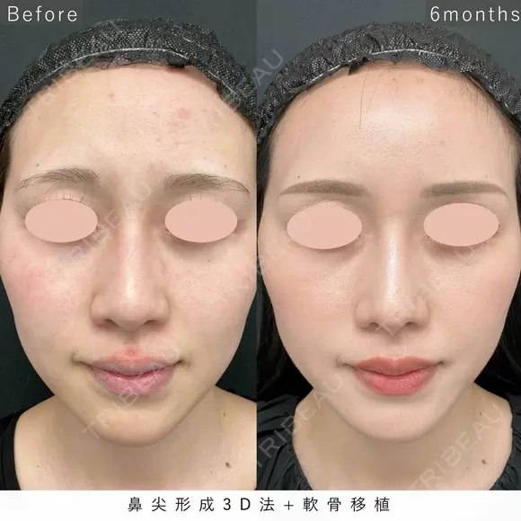 鼻尖形成3D法＋軟骨移植 before画像 メイン用