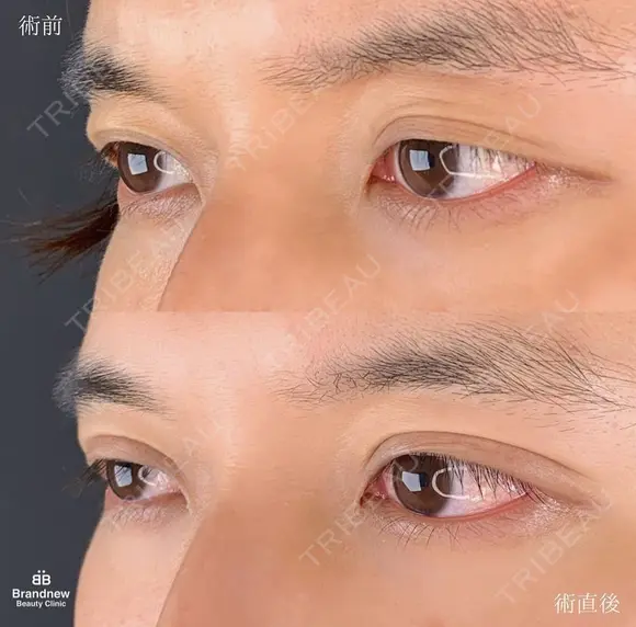 二重埋没 before画像 メイン用