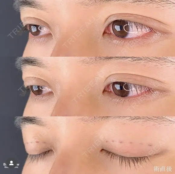 二重埋没 after画像 メイン用
